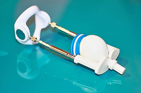 Extenseur un appareil pour une augmentation efficace d'un membre